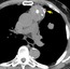 Axial images from an unenhanced chest CT at the level of the pulmonary trunk demonstrate an anterior mediastinal mass with aggressive features suggested by the coarse calcifications within it and the irregular <strong>lobulated margin(arrow)</strong> with the lung, suggestive of pulmonary invasion. In addition, there is a pulmonary nodule in the left upper lobe, confirmed by biopsy to represent a metastasis. 